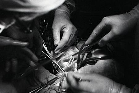 Prvá transplantácia pečene na Slovensku